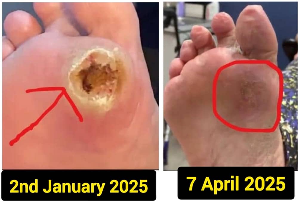 Chief Matthew's leg before and after BCG-35